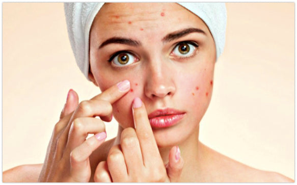 The Hidden Dangers of Taking Birth Control Pills for Acne